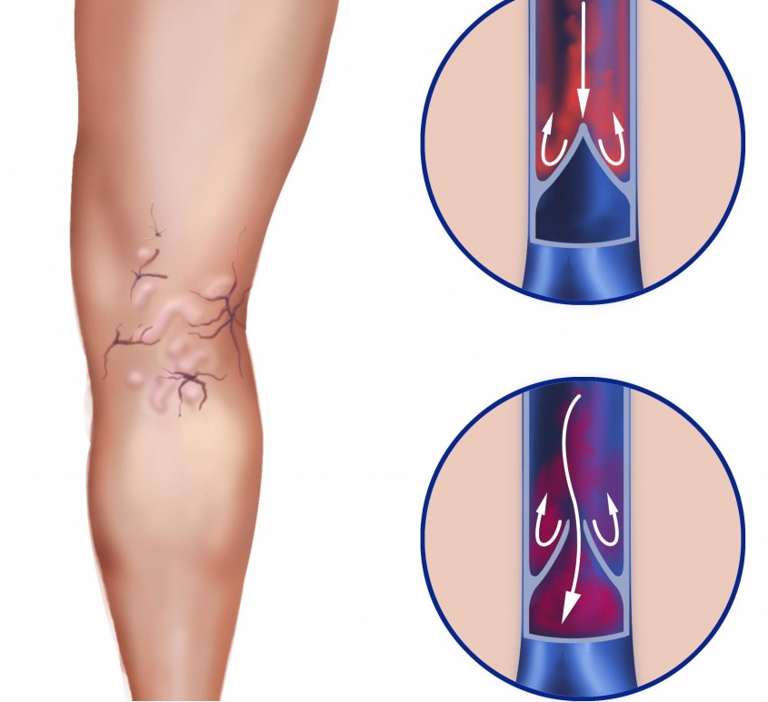 Варикоз Народні Методи Лікування