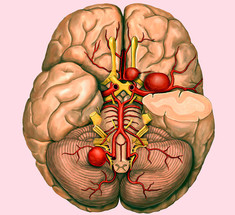 Аневризма головного мозга: 4 симптома смертельно опасного заболевания