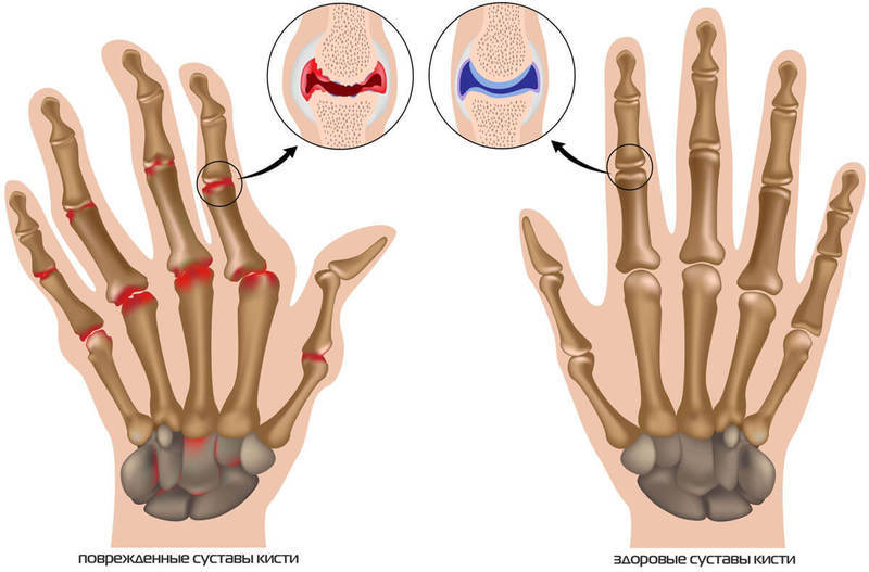 Упражнения для лечения артроза пальцев рук