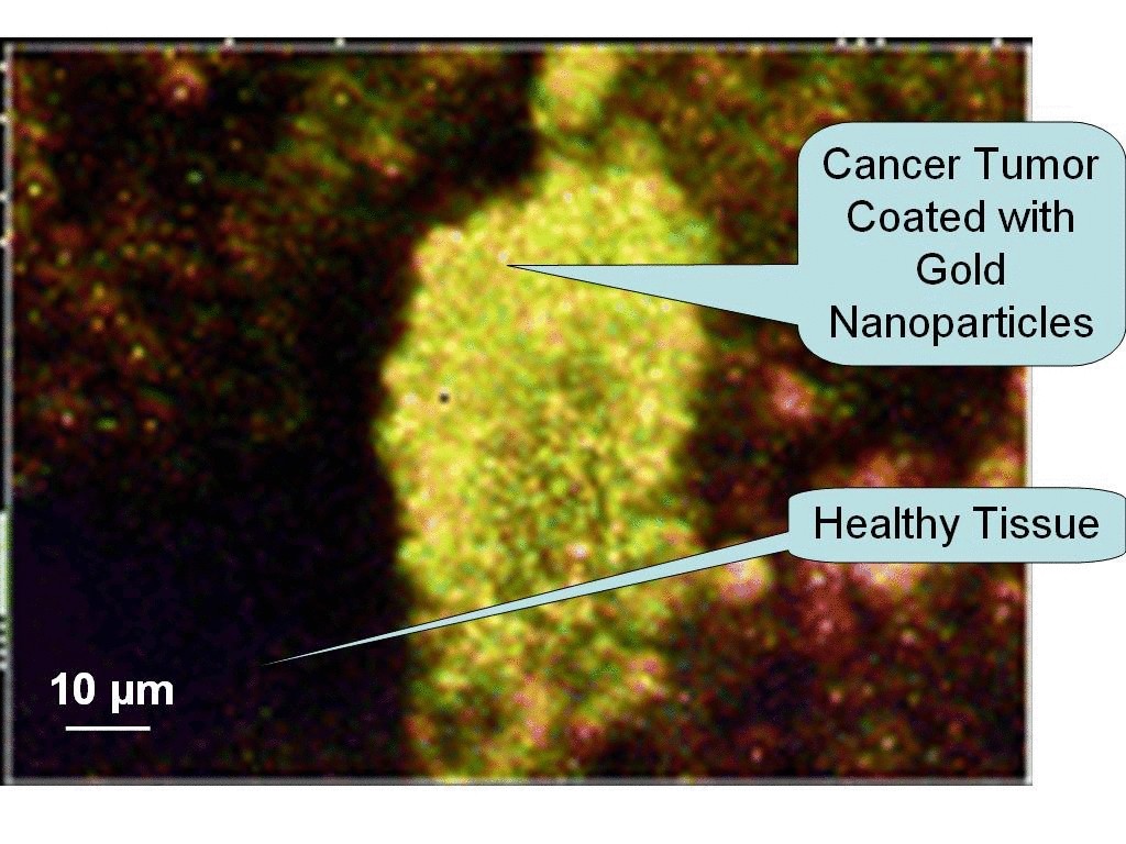Наночастицы золота определяют рак груди
