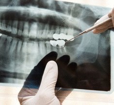 Ученые разработали новый метод протезирования зубов
