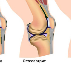 Эти 4 натуральные средства существенно облегчат боль при остеоартрите