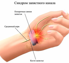 Растяжка для рук при синдроме запястного канала