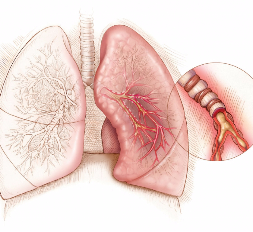 Как вывести слизь из организма