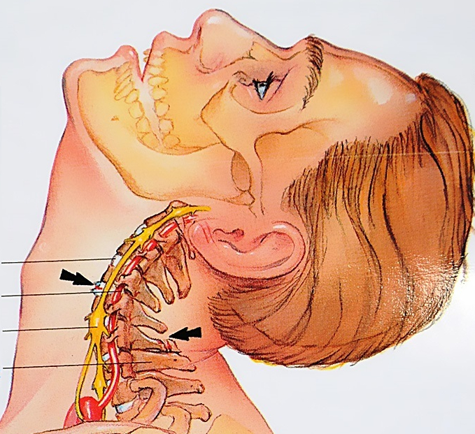 Остеохондроз шейный нерв. Хлыстовая травма шеи мкб 10. Нервные окончания в шейном отделе позвоночника. Хлыстообразный перелом шейного отдела.