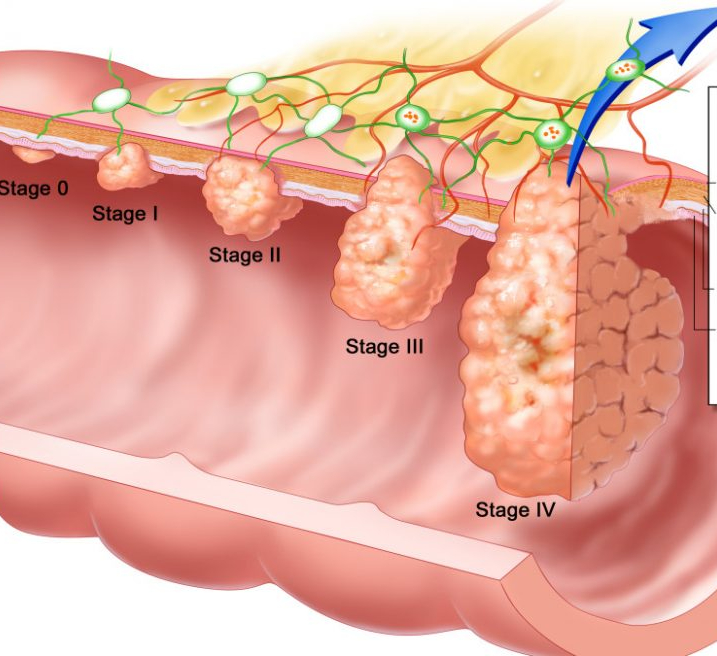Рак кишки стадии