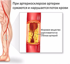 Атеросклероз сосудов ног: тревожные симптомы 