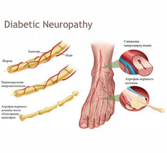 Добавки при диабетической нейропатии