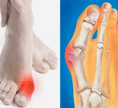 Баланс стопы: сильная остеопатическая техника от косточек на ногах