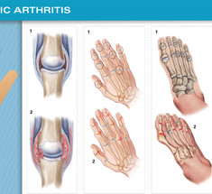 Псориатический артрит: 5 основных типов