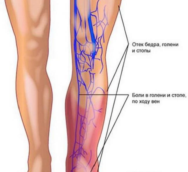 Подвздошная вена на ноге фото