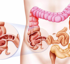 Что такое синдром дырявого кишечника и почему вам стоит об этом знать?