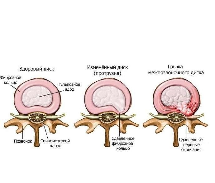 Йога при межпозвоночной грыже