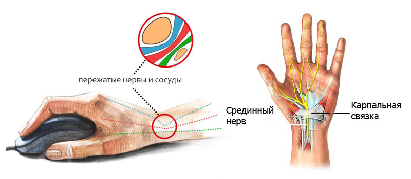 Растяжка для рук при синдроме запястного канала