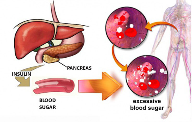 Что важно знать, если уровень сахара в крови выше нормы
