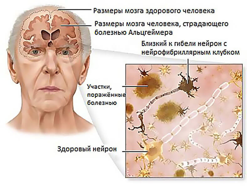 Зараженное мясо может быть причиной болезни Альцгеймера
