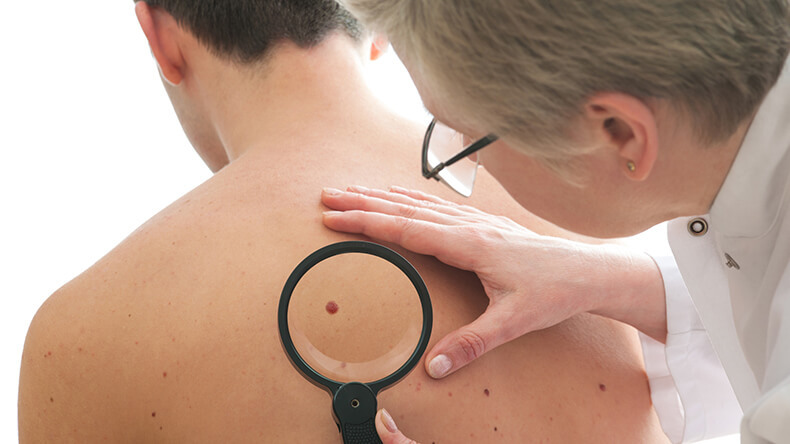 Рак кожи: симптомы, которые нельзя игнорировать