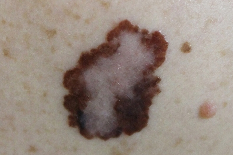 Рак кожи: симптомы, которые нельзя игнорировать