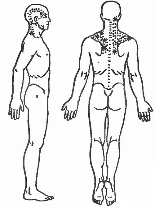 Растяжение трапециевидных  мыщц при боли в верхней части спины
