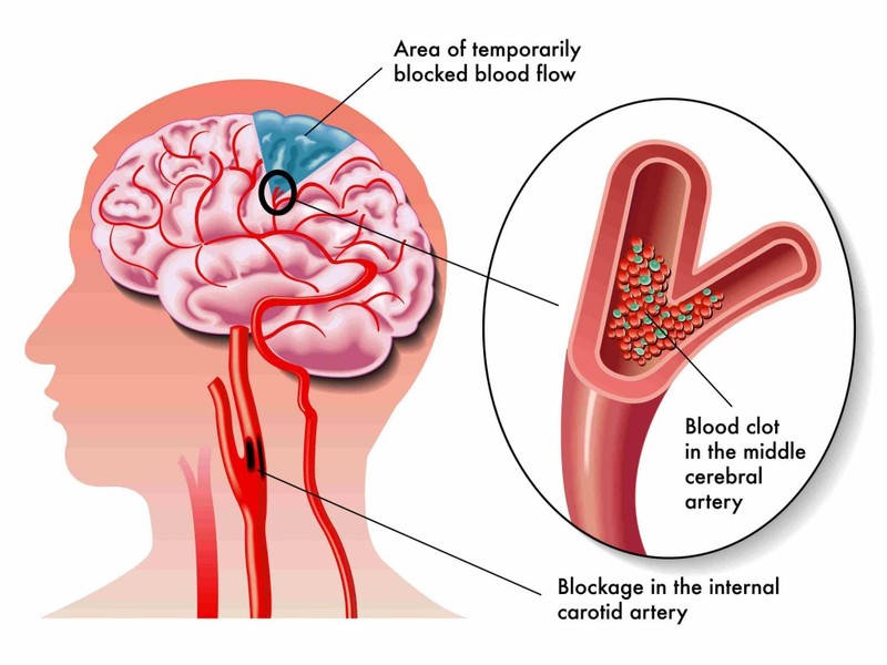 Восстановление кровообращения мозга методами народной медицины
