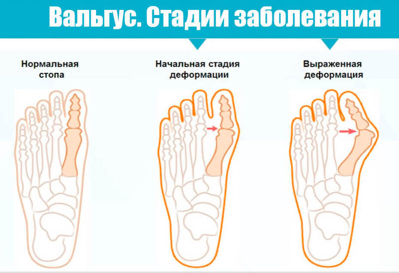 Косточка на ноге: Почему происходит вальгусная деформация стопы