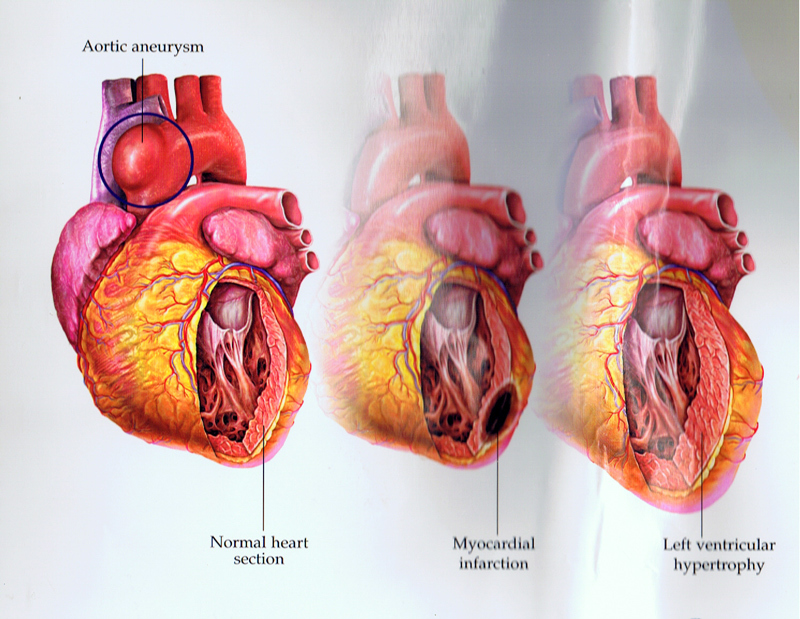 Сердечно-сосудистые заболевания: Как помочь сердцу 
