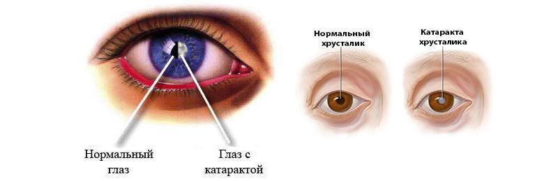 Двоение в глазах: Причины и методы лечения 