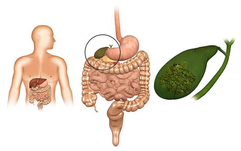 Желчный пузырь: Первые симптомызаболевания