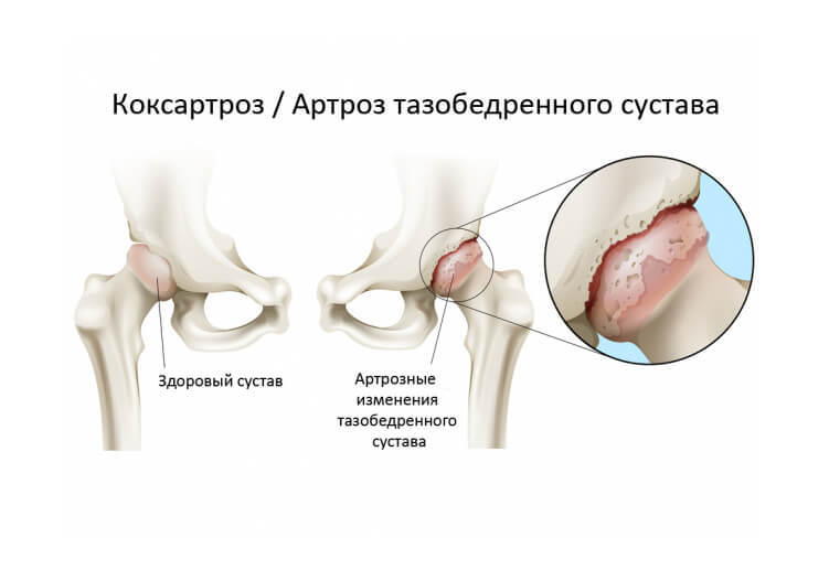 Коксартроз тазобедренного сустава: Лечебная гимнастика 