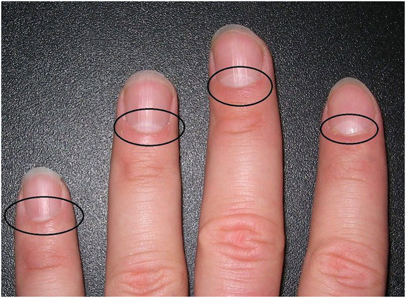 Тревожный симптом: Почему могут исчезнуть белые лунки на ногтях