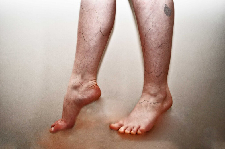 Плохое КРОВООБРАЩЕНИЕ в ногах - как проявляется + эффективные методы лечения