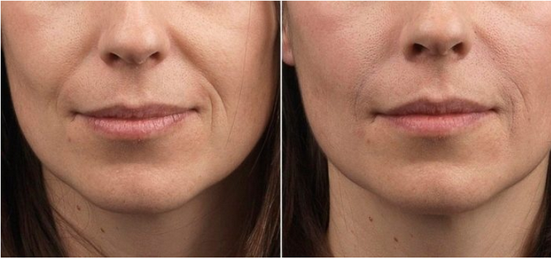 Сохранить Лицо: ТОП-Упражнения для восстановления лицевых мышц 