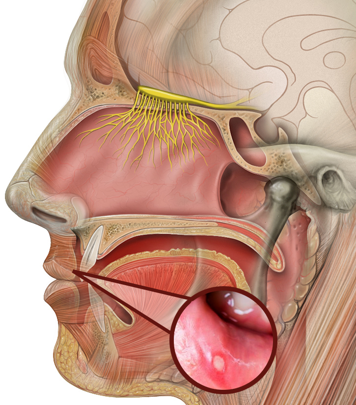 Белые язвочки во рту: причины и лечение