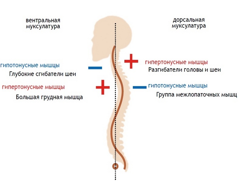 Верхний перекрестный синдром: сутулые плечи и выдвинутая вперед шея