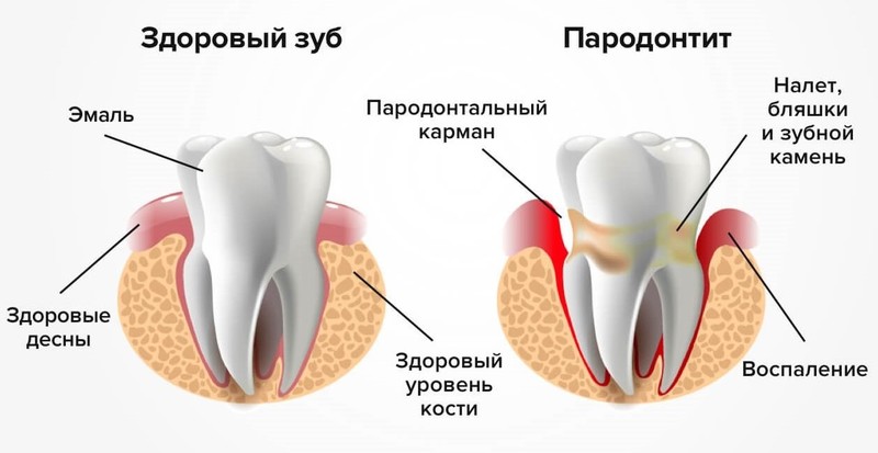 Простой способ сохранения здоровья зубов до старости