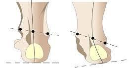 Вальгусная деформация стопы: упражнения и рекомендации ортопедов