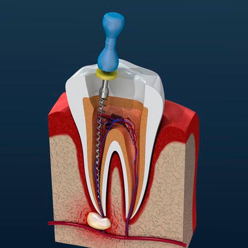 Что важно знать про зубные импланты