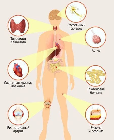 Как связаны микрофлора и аутоиммунные заболевания: что говорит наука?