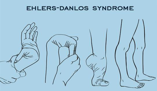 Синдром Элерса-Данлоса: что он из себя представляет?
