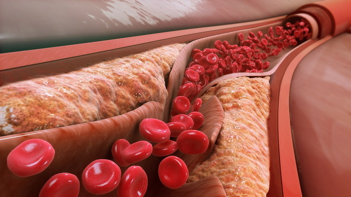 Атеросклероз и тромбоциты